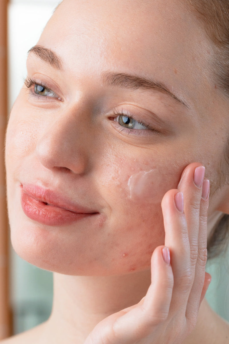 Effet rebond de l'acné après le soleil : pourquoi et comment agir ?